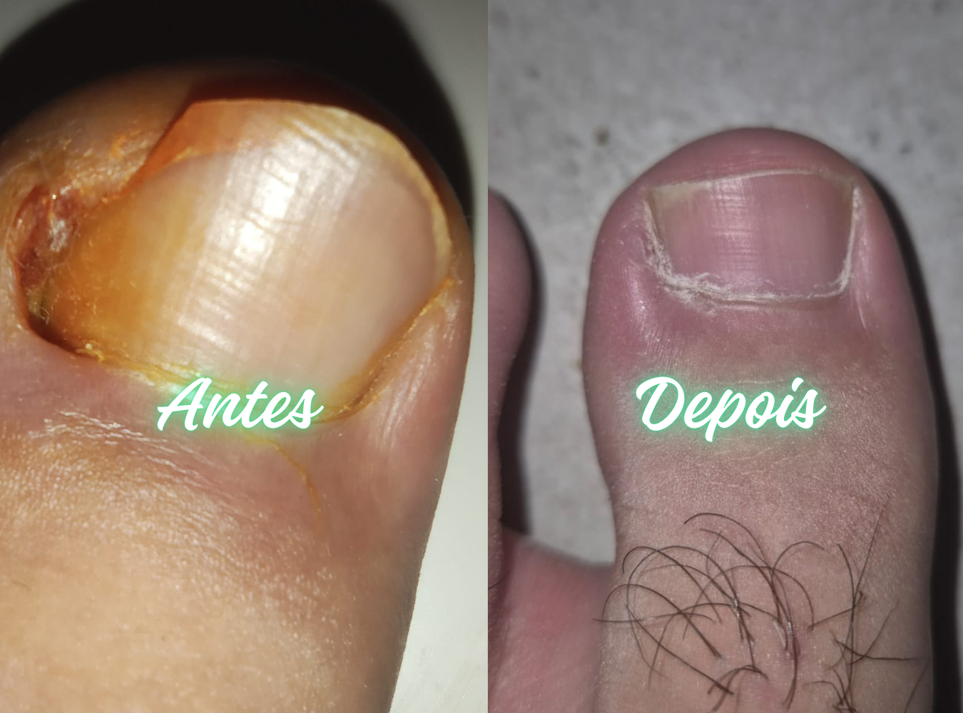 Antes e Depois Podologia 1