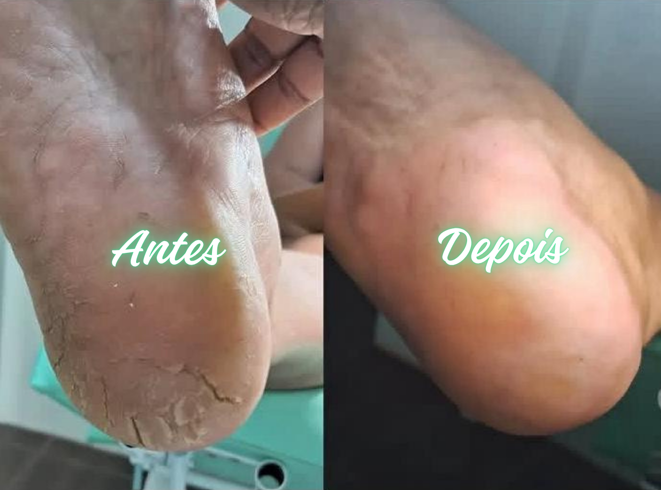 Antes e Depois Podologia 2
