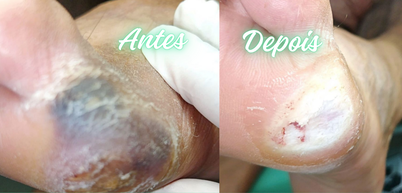 Antes e Depois Podologia 3 Desktop
