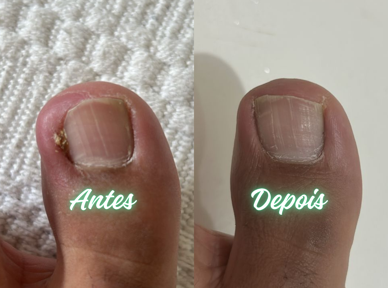 Antes e Depois Podologia 4